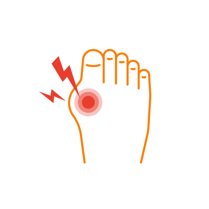 Acute attacks of gout
