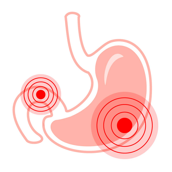 Treatment and relapses of duodenal and gastric ulcers