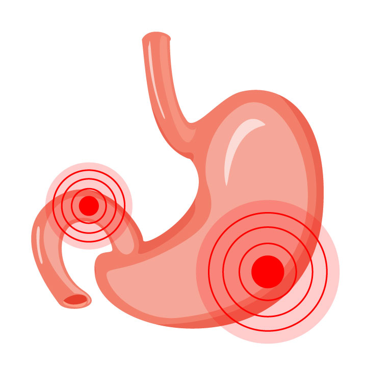 Gastric ulcers and duodenal ulcers