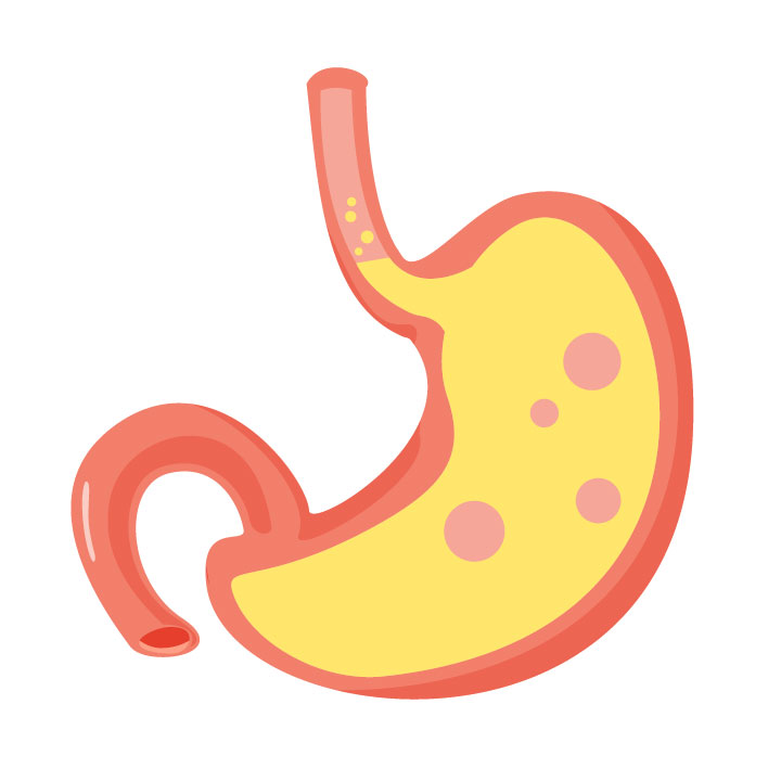 Gastroesophageal reflux disease (GERD)