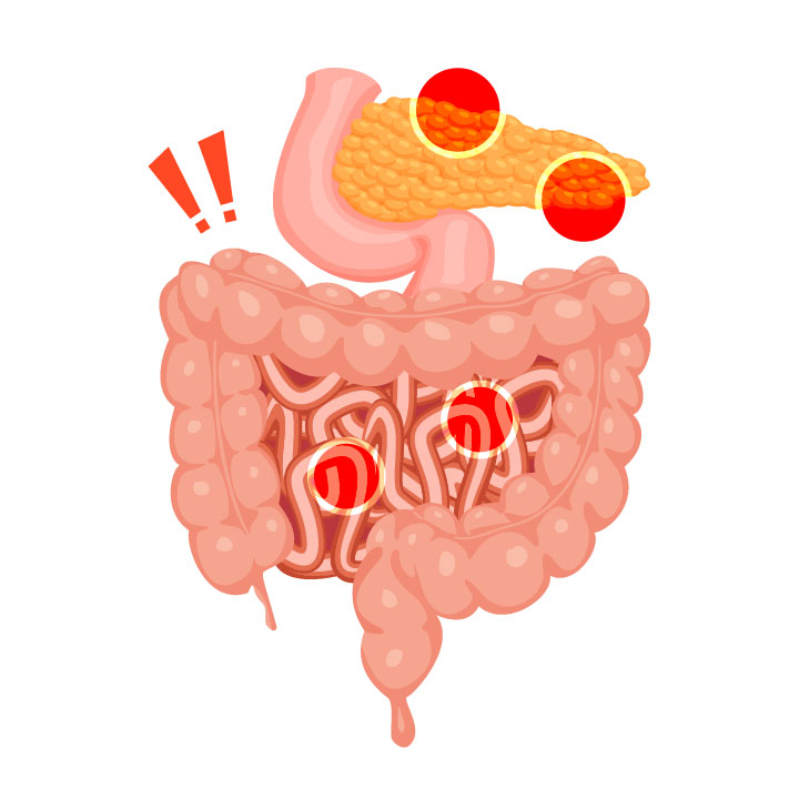 Zollinger-Ellison syndrome