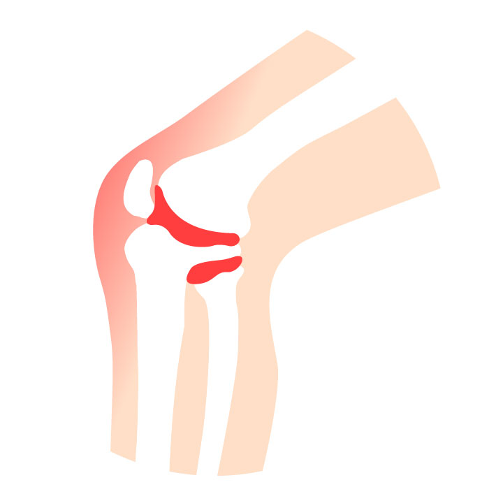 Pain and discomfort associated with rheumatoid arthritis and fasciitis.