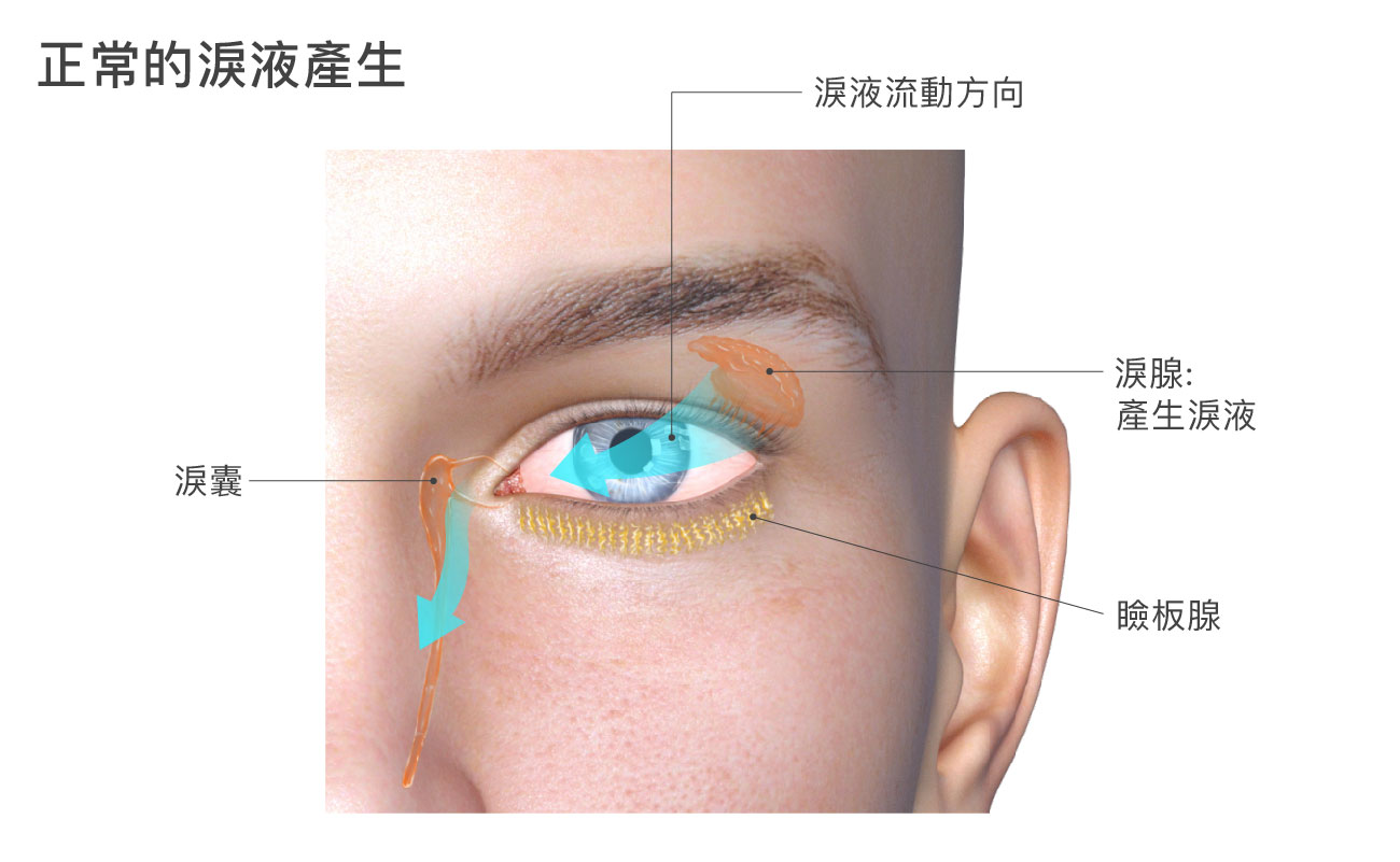這張圖片展示了正常的淚液產生過程。標示了淚腺、瞼板腺以及淚液流動的方向。淚腺負責產生淚液，淚液通過瞼板腺流向眼球表面，最終流入淚囊。這些構造共同作用，保持眼睛的濕潤和健康。這張圖片有助於理解眼部生理結構及其在保持眼部舒適中的重要性。 width=