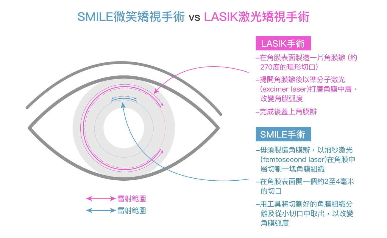 SMILE微笑矯視手術 vs LASIK激光矯視手術