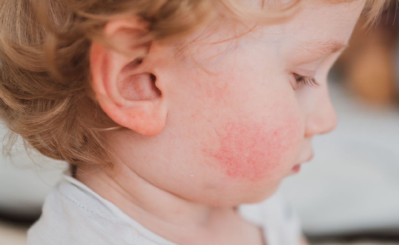 嬰兒臉部出現濕疹紅疹，皮膚發炎癢癢的樣子，使用濕疹自然好的護膚產品可以改善皮膚狀況。
