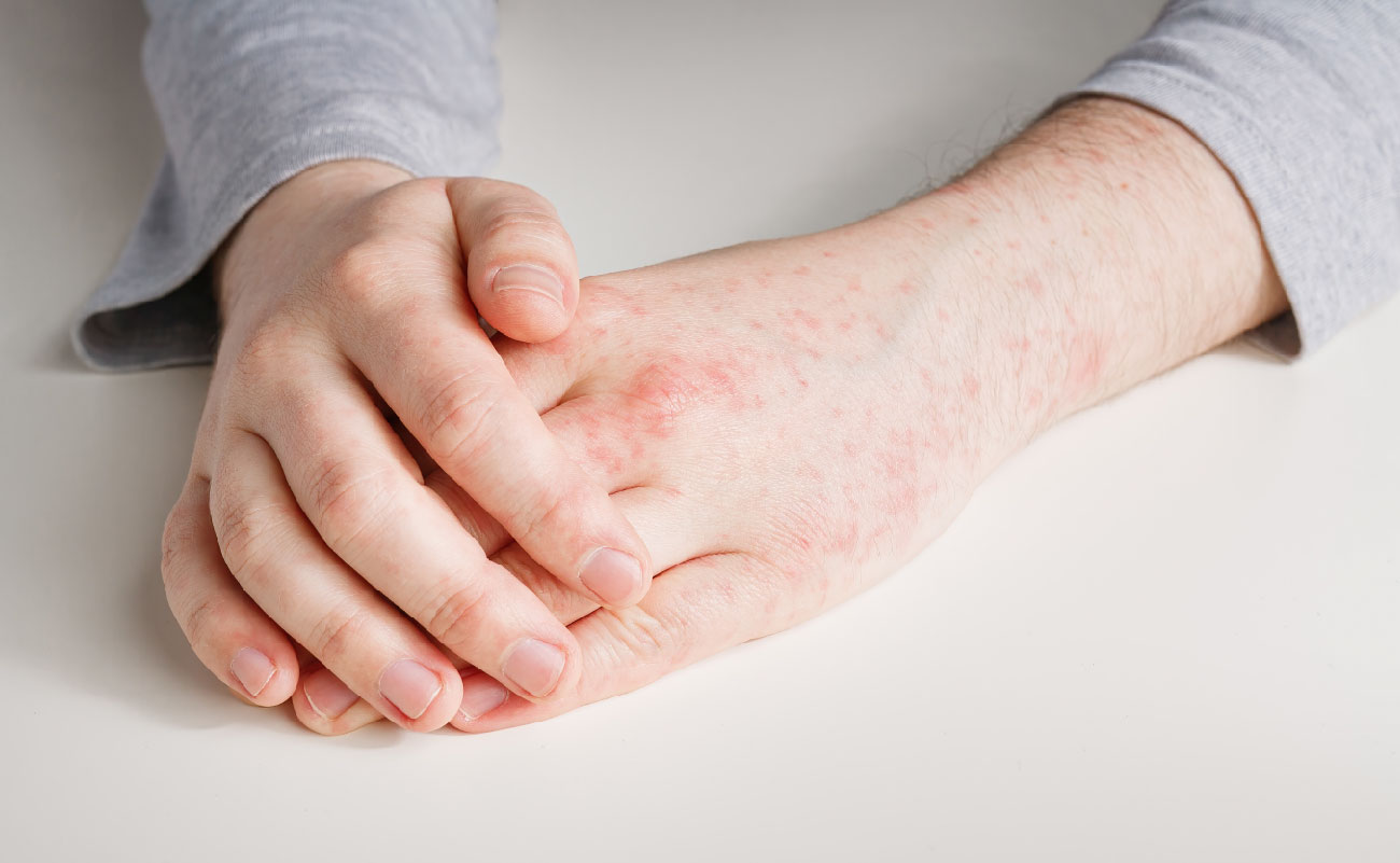 成人手部濕疹紅疹，皮膚發炎乾燥，雙手交握，使用濕疹自然好的護膚產品，有助於舒緩症狀。
