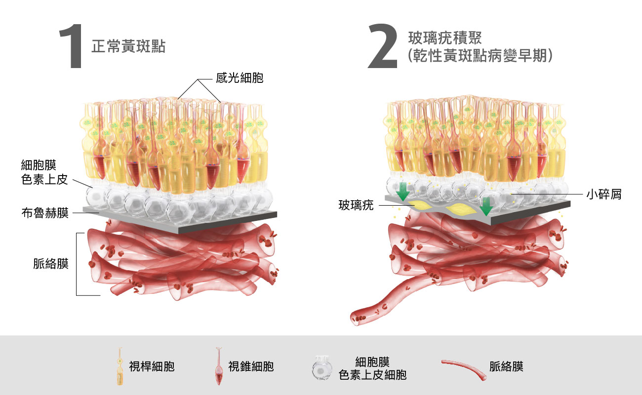 黃斑點病變階段變化