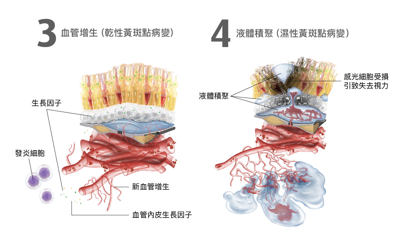 黃斑點病變階段變化