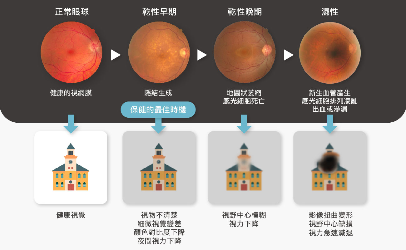 黃斑點病視網膜變化與視覺惡化型態