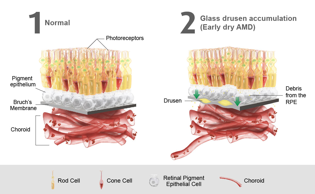 Macular Degeneration