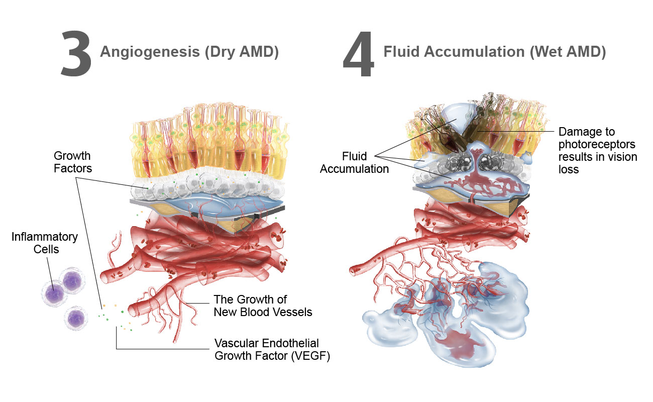 Macular Degeneration