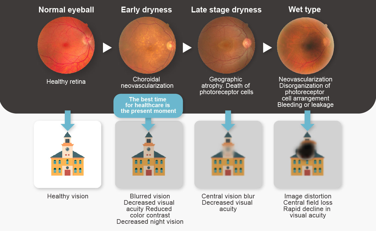 Symptoms of macular degeneration