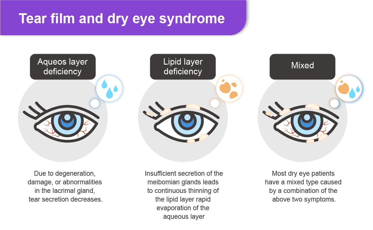 What Are the Types of Dry Eye Syndrome?