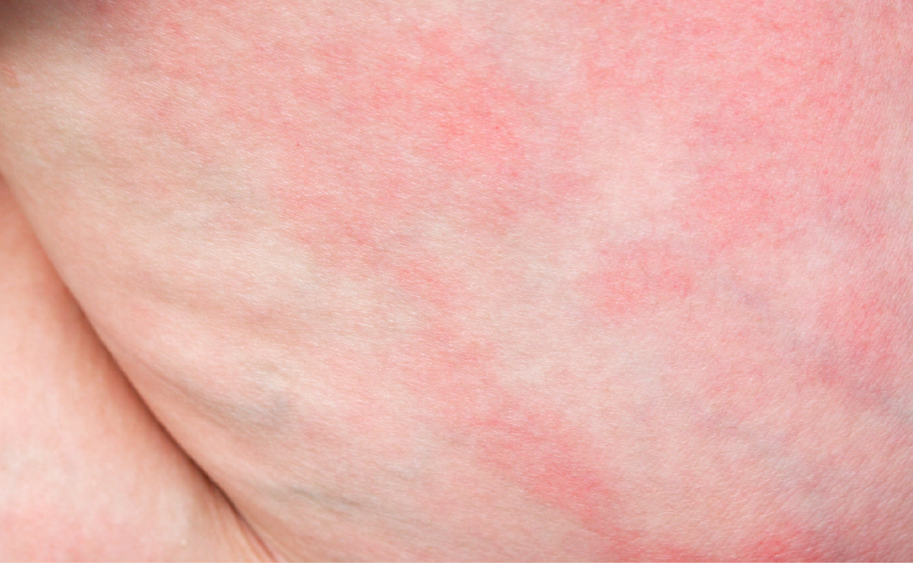 Symptoms of Irritative Skin :