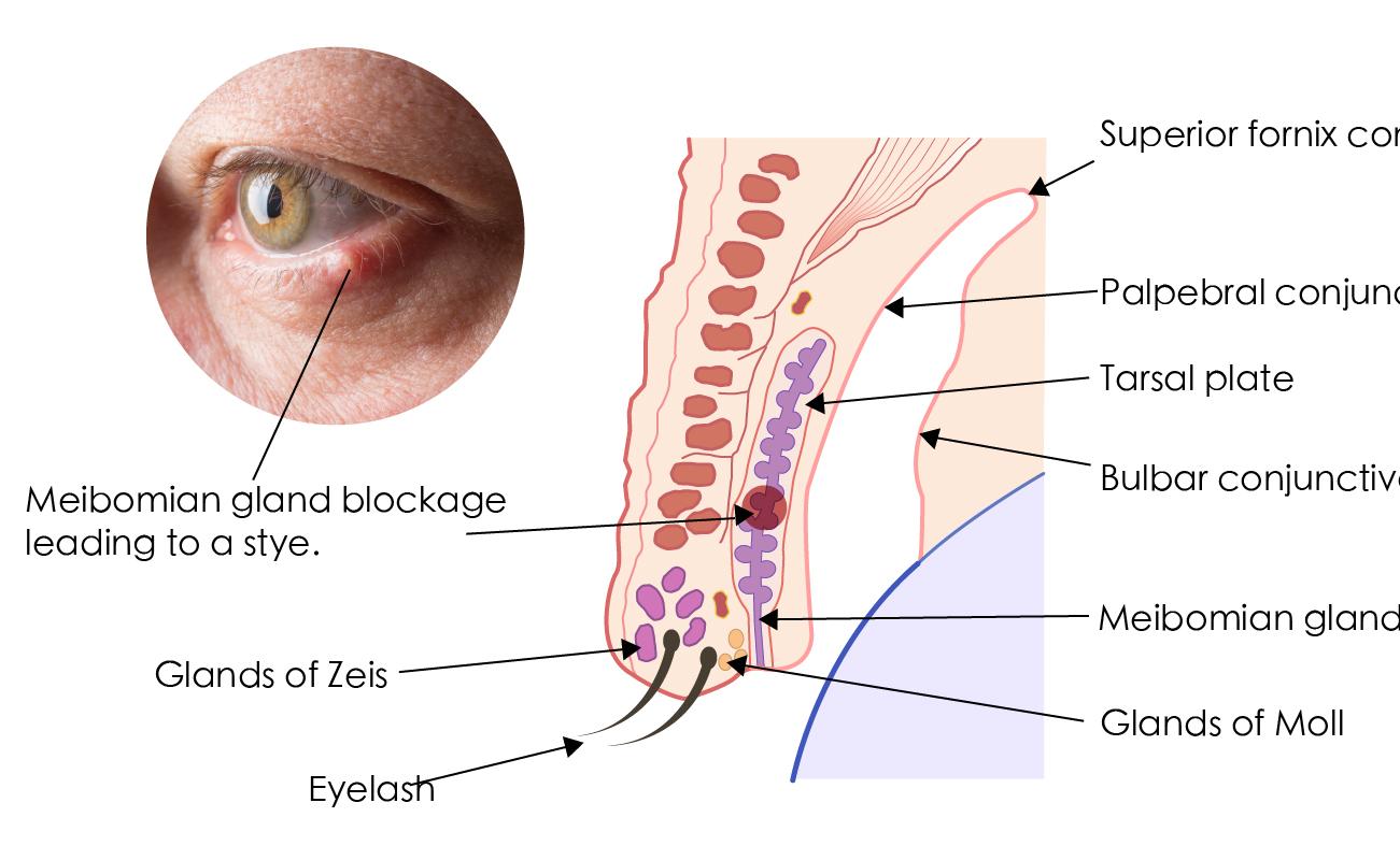 Severe Symptoms