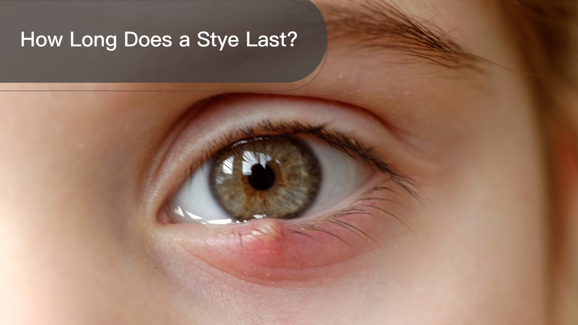 How Long Does a Stye Last?