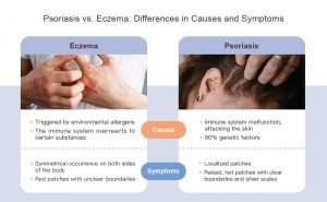 Psoriasis vs. Eczema: Differences in Causes and Symptoms Eczema Causes 