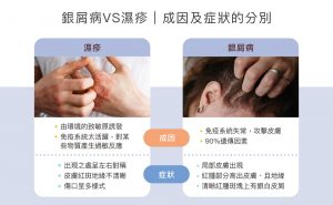 銀屑病與濕疹成因及症狀的分別