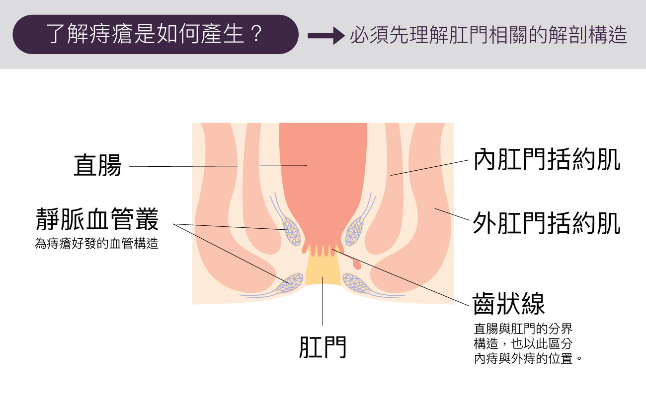 痔瘡原因