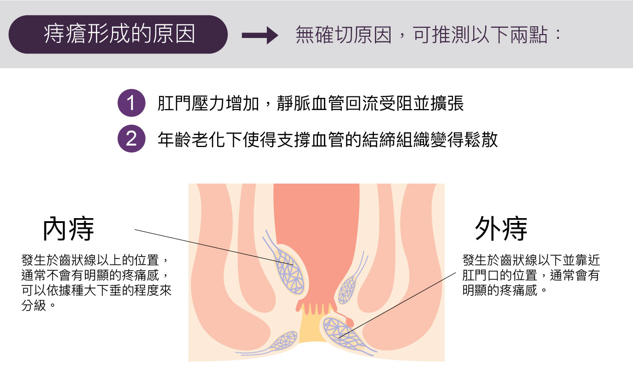 痔瘡原因