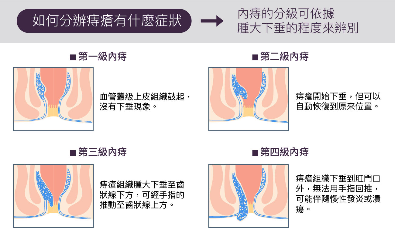 痔瘡原因