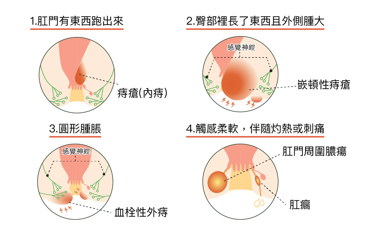 痔瘡原因