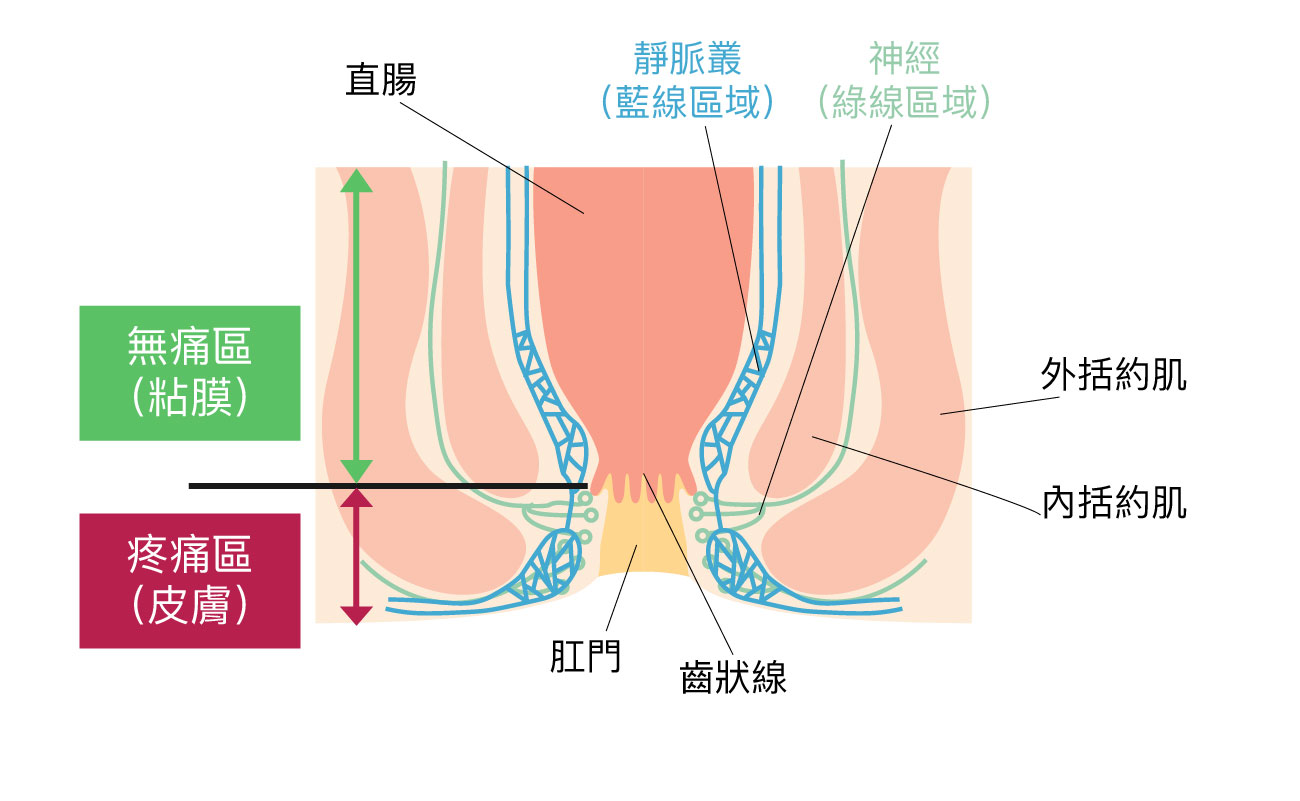 痔瘡原因