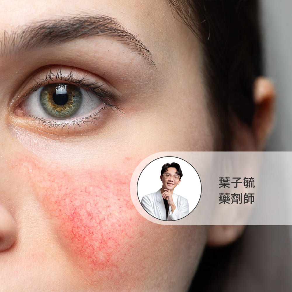 敏感肌臉部泛紅與換季乾癢的 Ectoin 依克多因保養修護指南